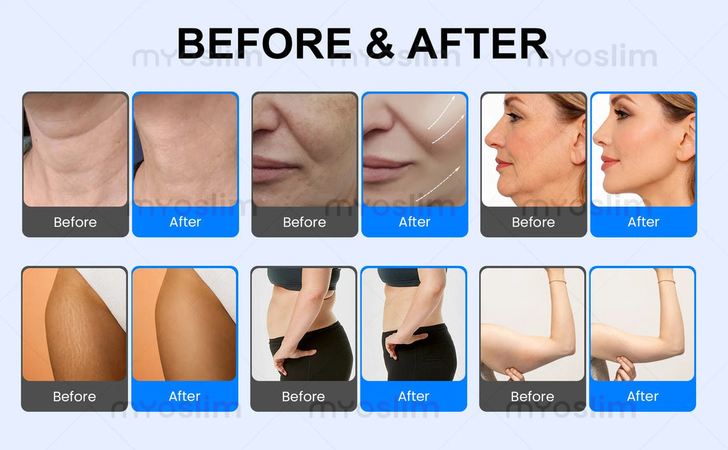 Professional Non Invasive Cold Wave Shaping EMS RF Fat Reduction Equipment for Body Contour Slimming