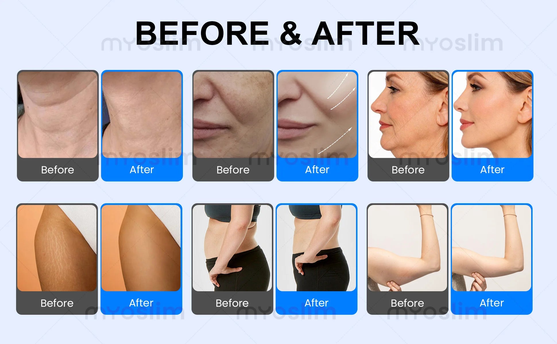 Professional Non Invasive Cold Wave Shaping EMS RF Fat Reduction Equipment for Body Contour Slimming
