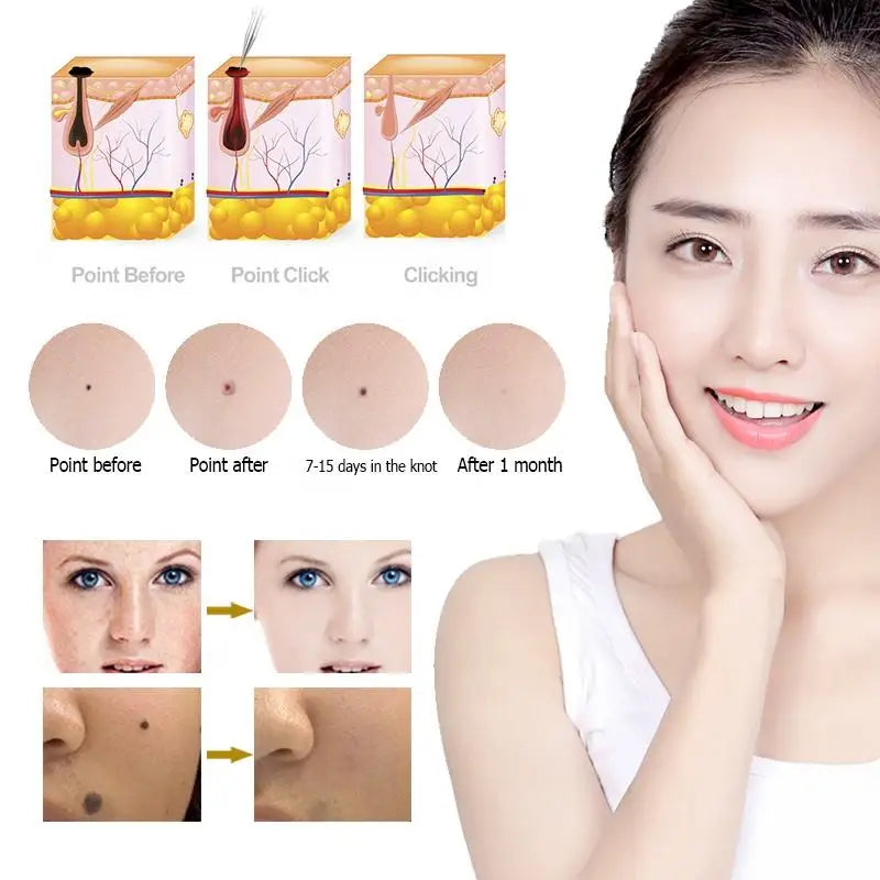 PAKISS FY-107 Beauty Pen for Skin Care