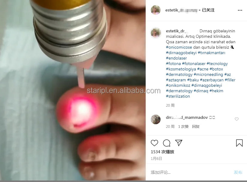 Pinpointe Nail Laser Diode 40W Dual Wave 980nm 1470nm Anti Fungus Toenails Podologia Onychomycosis Podiatry Foot Wart Machine