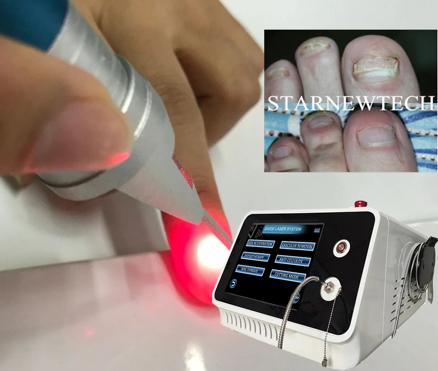 Pinpointe Nail Laser Diode 40W Dual Wave 980nm 1470nm Anti Fungus Toenails Podologia Onychomycosis Podiatry Foot Wart Machine
