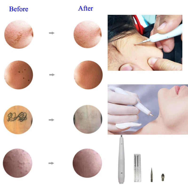 Auro Spot Remover Facial Warts Remover Skin Tag and Mole Removal Machine Electro Cautery Pen