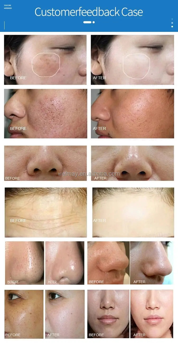 Factory OEM ODM Oxigen Facial Machine Jet Peel Moisturizer Pore Cleaner Skin Rejuvenation Hydradermabrasion Oxygen Portable