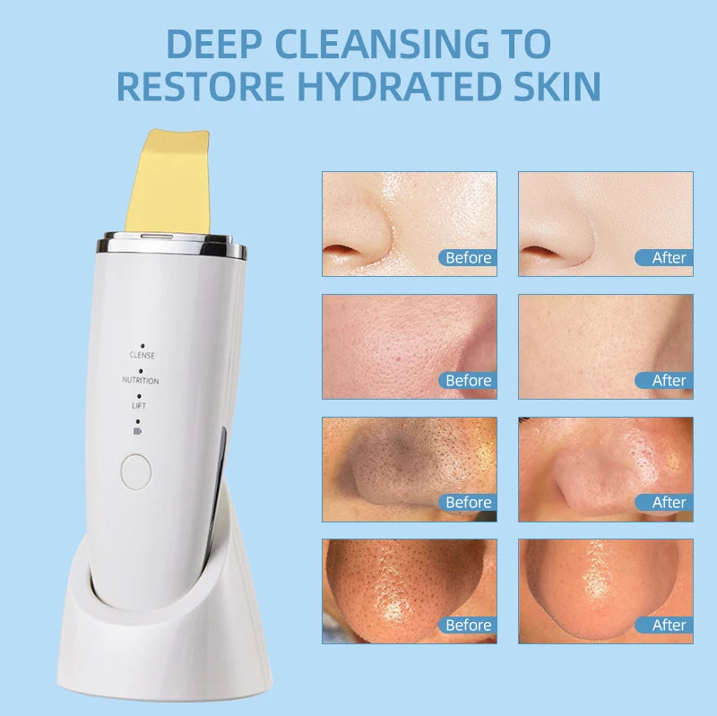 LESEN Skin Care Ultrasonic Skin Scrubber Blackheads Whiteheads Exfoliator Vibrating Facial Scraper Pore DeepCleanser Face Lifter