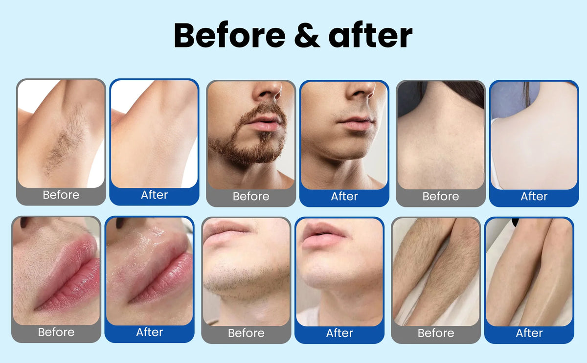 Professional 808nm diode hair removal machinePermanent Hair Removal equipment, Private and Painless Full body Hair Removal