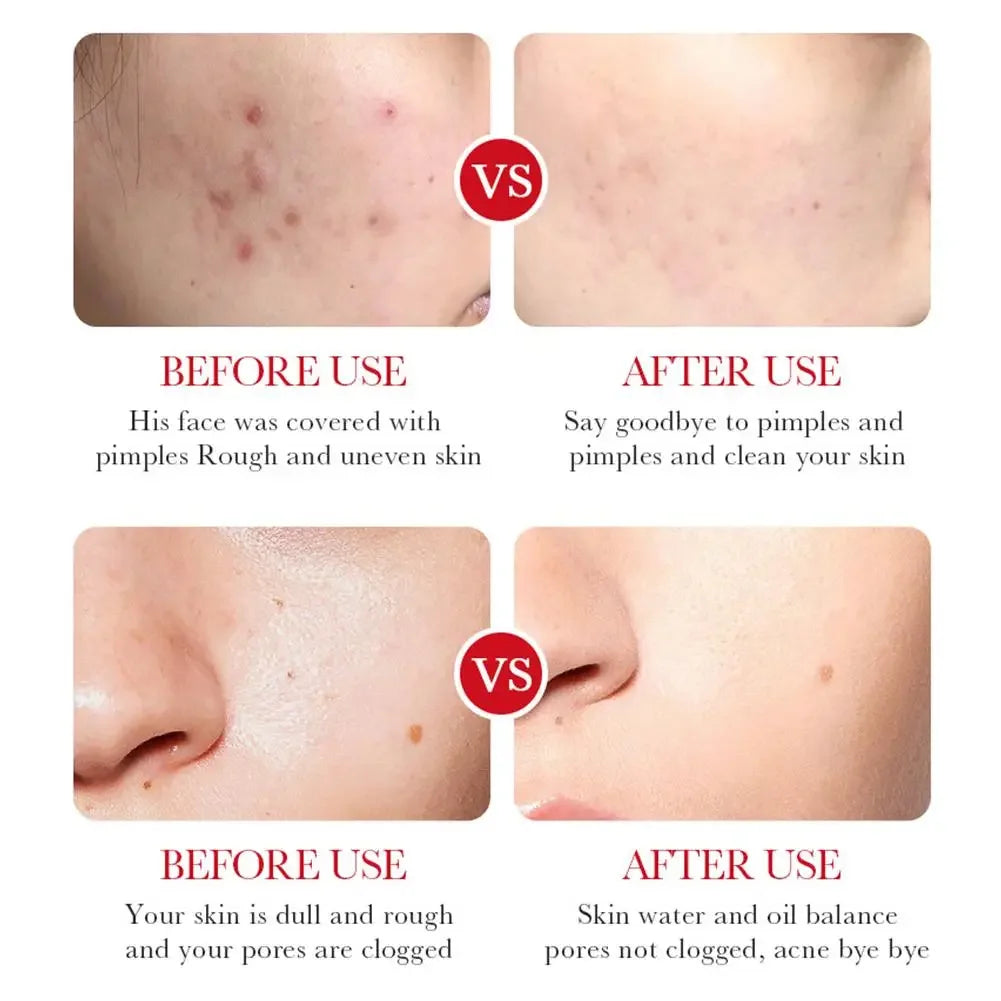 Salicylic Acid Shrink Pore Cream Elimination Large Pores Remove Blackehead Face Smooth Repairing Skin Care Product