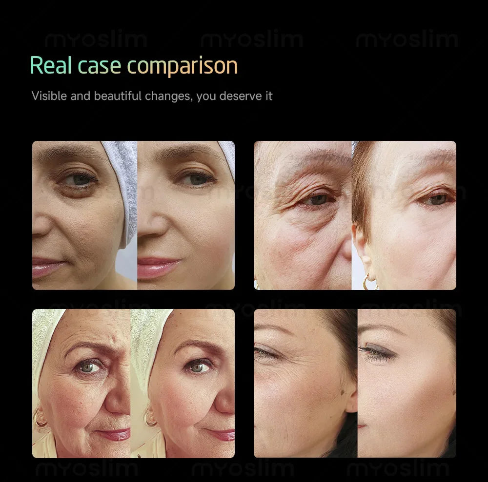 New Popular 25D 360MAX Beauty Equipment Machine for Facial Tightening Slimming And Fat Reduction Latest Model