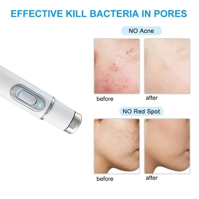 Facial Beauty Device Eye Blue Light Black Eye Circles Facial Care Tool Lightening Texture Maintaining Eye Bags