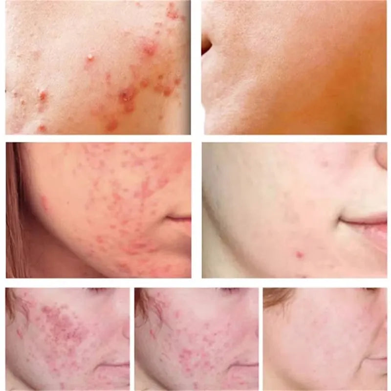 Salicylic Acid Acne Treatment Face Cream Repair Pimple Spots Deep Cleaning Pore Anti-acne Scar Oil Control Moisturizer Skin Care