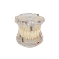 VVDental Teeth Repair Model Disease Teeth Model for Dentist Student Practice Training Studying Oral Medical Dentistry Tools