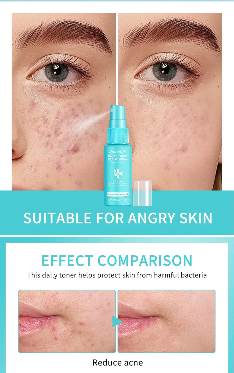 Calming Rescue Facial Spray For Sensitive Skin Hypochlorous Acid Spray Helps Reduce Redness Breakouts Soothing Balancing Spray