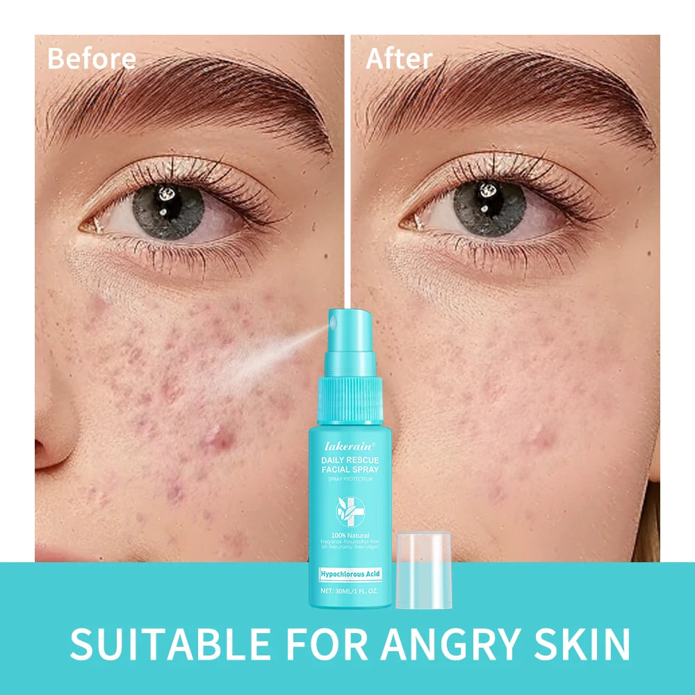 Calming Rescue Facial Spray For Sensitive Skin Hypochlorous Acid Spray Helps Reduce Redness Breakouts Soothing Balancing Spray