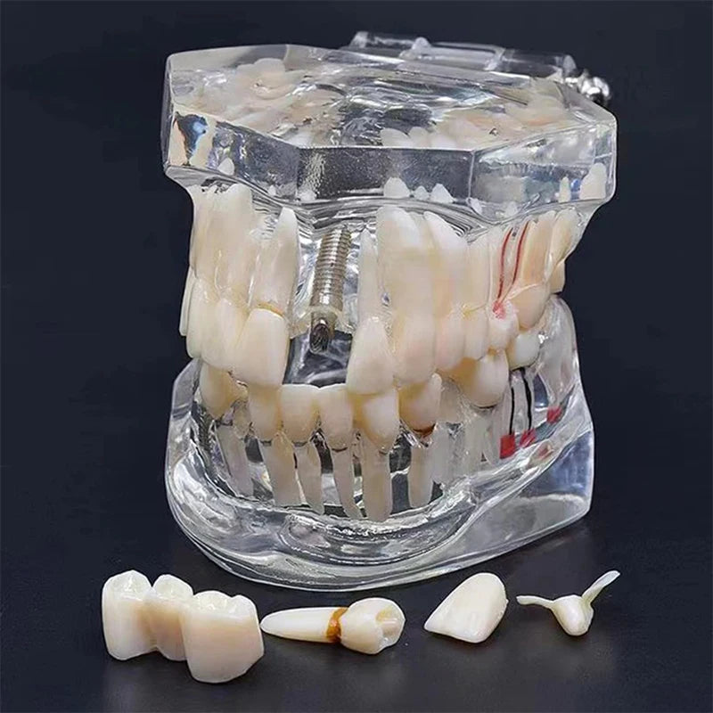 VVDental Teeth Repair Model Disease Teeth Model for Dentist Student Practice Training Studying Oral Medical Dentistry Tools
