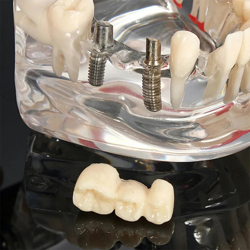 VVDental Teeth Repair Model Disease Teeth Model for Dentist Student Practice Training Studying Oral Medical Dentistry Tools