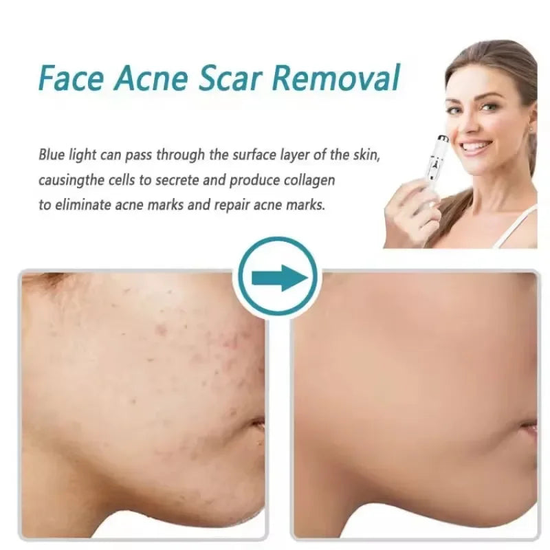 Facial Beauty Device Eye Blue Light Black Eye Circles Facial Care Tool Lightening Texture Maintaining Eye Bags