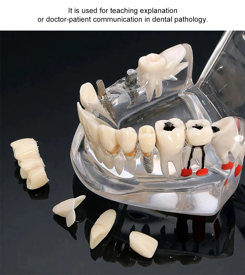 VVDental Teeth Repair Model Disease Teeth Model for Dentist Student Practice Training Studying Oral Medical Dentistry Tools