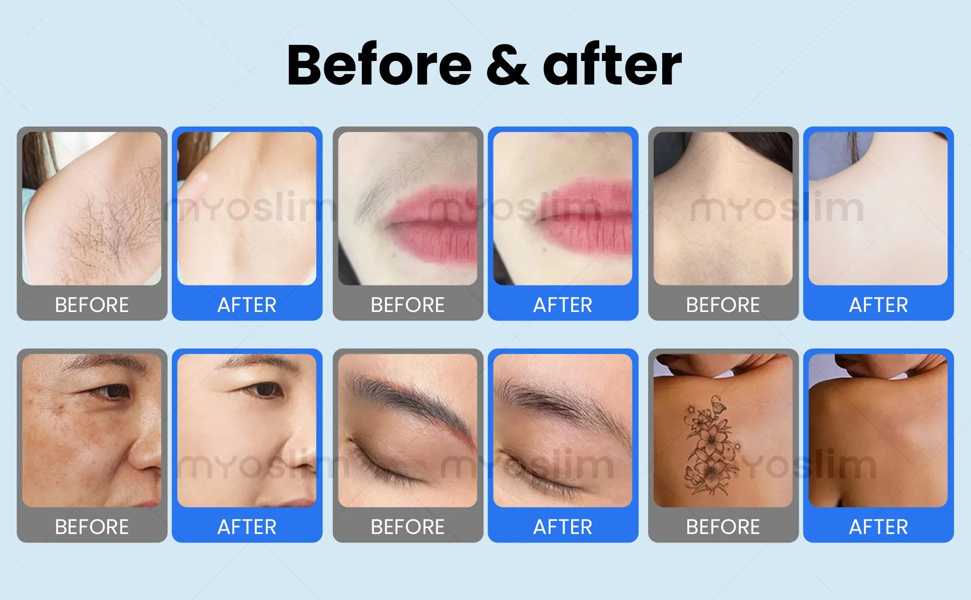 Myoslim 2In1 FAC 10Bars Diode 808 Lase Hair Removal Machin Picosecond Tattoo Removal Machine 4Wavelength Skin Rejuvenation
