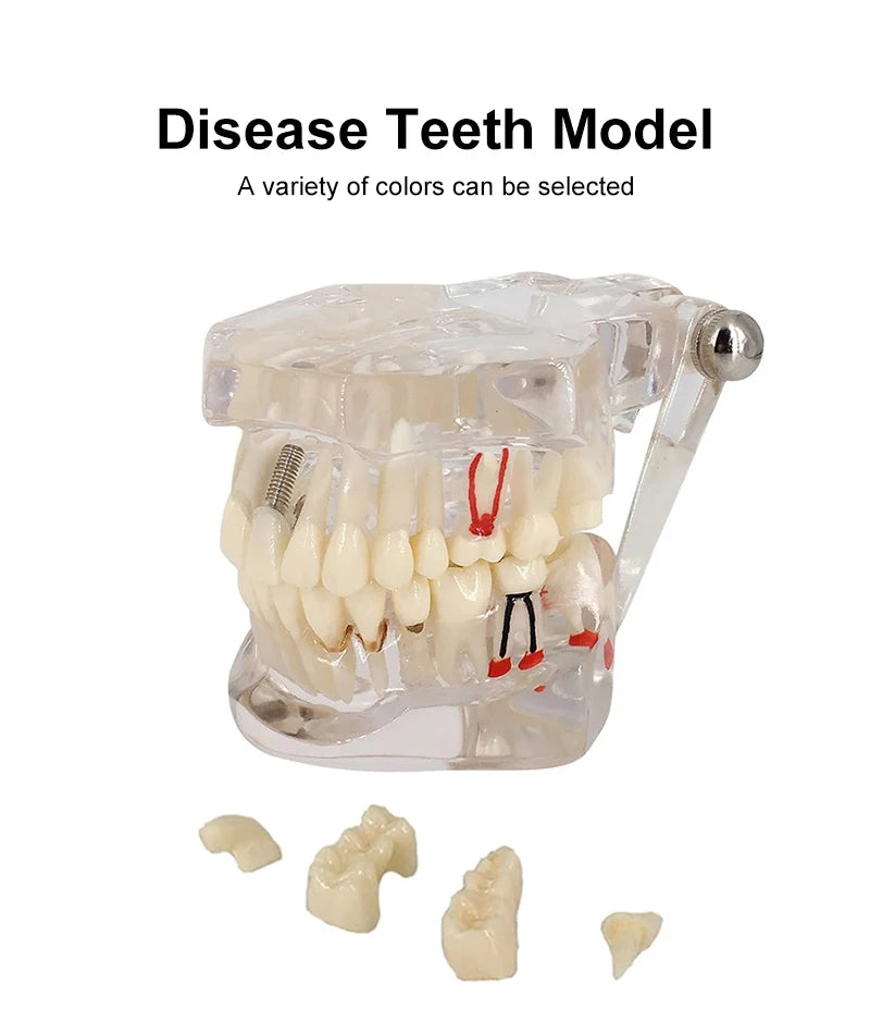 VVDental Teeth Repair Model Disease Teeth Model for Dentist Student Practice Training Studying Oral Medical Dentistry Tools