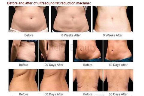 New 8 In 1 Vacuum Facial Massager 40k Ultrasonic Fat Cavitation Cellulite Reduction Liposuction Weight Loss Slimming Machine Spa