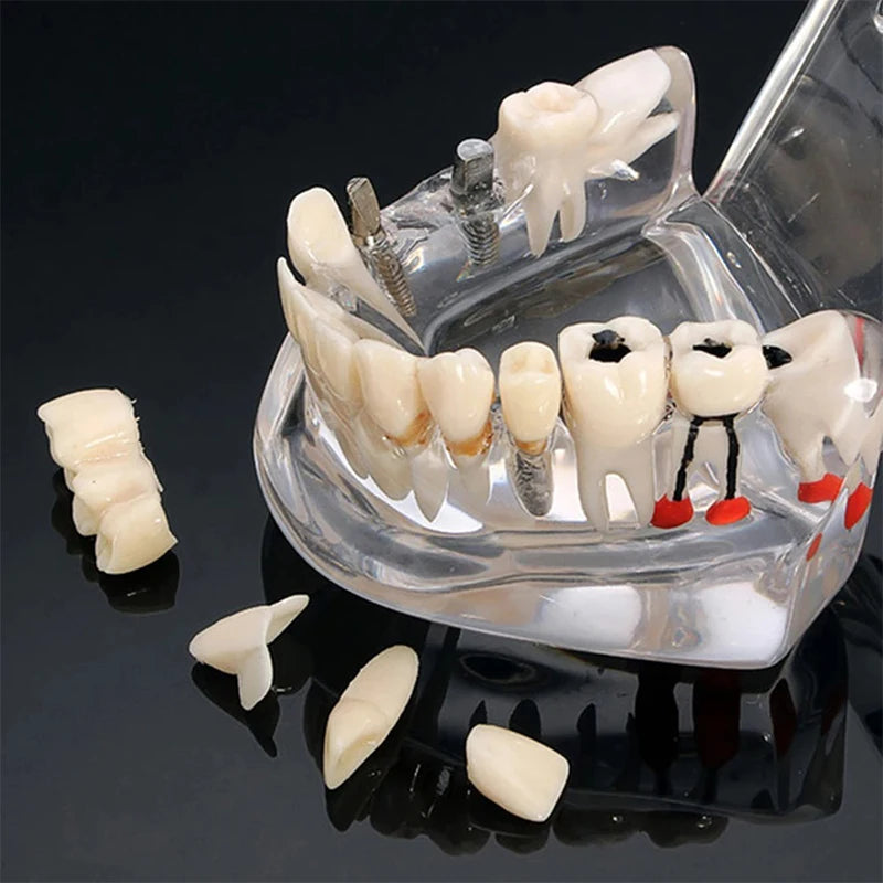 VVDental Teeth Repair Model Disease Teeth Model for Dentist Student Practice Training Studying Oral Medical Dentistry Tools