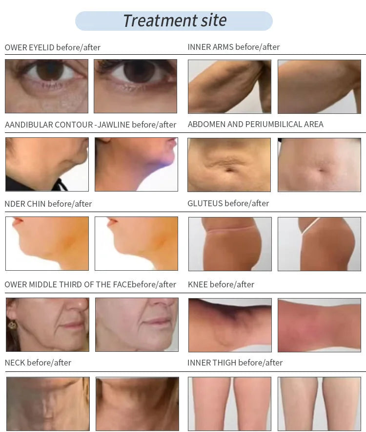 Myoslim 980+1470+635+450nm Diode Laser Lipolysis System Anti-Inflammatory Therapy Body Slimming Face Lifting Machine