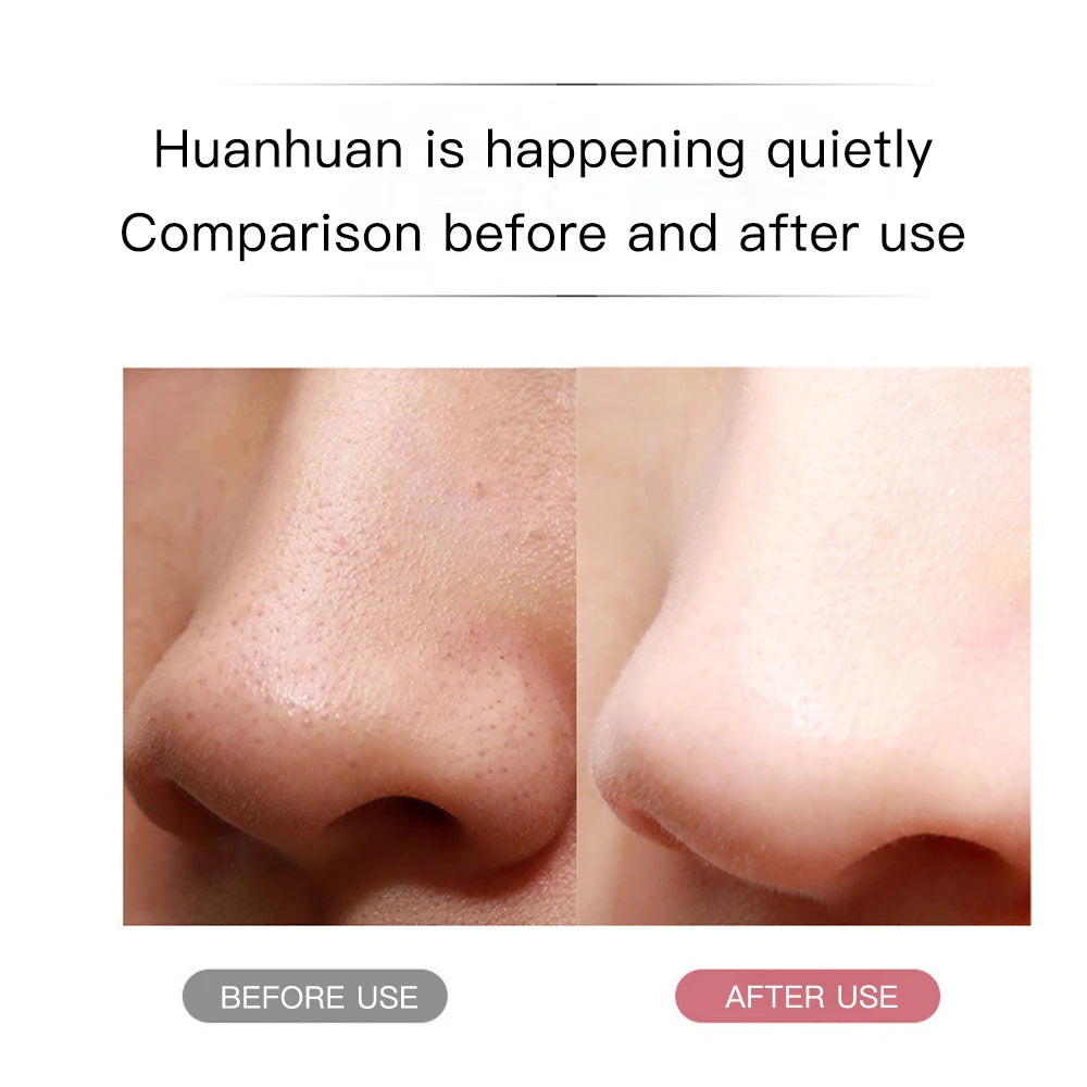 Ultrasonic Peeling Machine Skin Care Blackhead Remover Device Face Cleaning Pore Cleanser Facial Lifting Massager Skin Scrubber